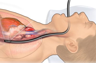 Gastroscopy