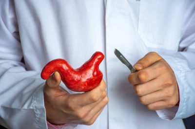 Surgeon held scalpel over anatomical model of human stomach, holding it in his hand against background of body in a white uniform. Concept photo surgical treatment of stomach ailments and procedures